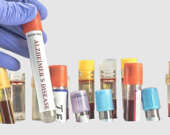 P Tau Blood Test